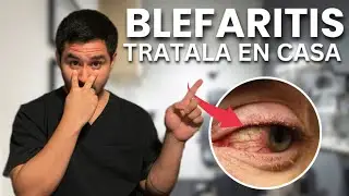 BLEFARITIS: ¿QUÉ ES Y CÓMO SE TRATA?