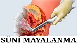Süni mayalanma qadına ağrı verirmi?