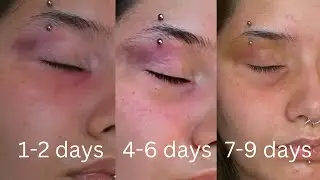 FAKE BRUISE TUTORIAL SFX