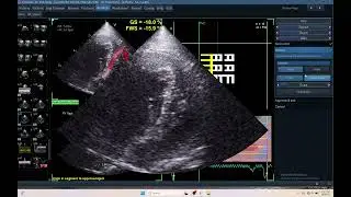 IQ 703 RV GLS ECHOCARDIOGRAPHY