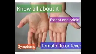 Case study of Tomato flu or Tomato fever | Symptoms and Origin 🤒🦠| #upscprepration #upscanalysis