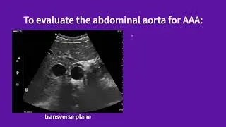 Vscan Air&trade; | Using presets for evaluations: abdominal aorta