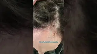 Tratamiento para Ca&iacute;da de Pelo  - Dr. Ang&eacute;lica Dom&iacute;nguez Dermat&oacute;loga en bogot&aacute;