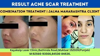 Result Acne Scar Treatment | Combination Treatment | Jalna Maharashtra Client