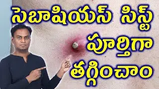 సెబాషియస్ సిస్ట్ కి చికిత్స | Permanant Cure For Sebaceous cyst Oil Gland Cyst Homeopathy Treatment