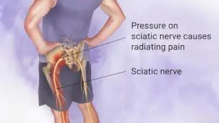 What is Sciatica? - Westside Pain Clinic - Springfield, IL