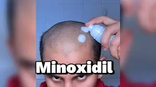 Hair Growth Tips Minoxidil - Men, Women Alopecia | LifeofNiravPatel