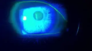 Dry Eye Assessment: Tear Break Up Time