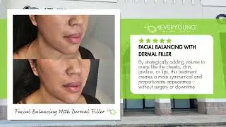 Facial Balancing with Restylane | How Dermal Fillers Create Natural-Looking Harmony in Houston Voss