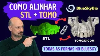 STL não alinha com a tomografia? Veja todas as formas de linkar no BlueSkyBio