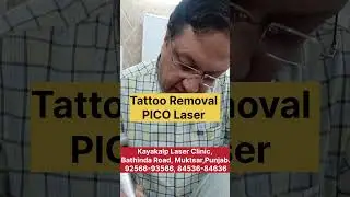 Permanent Tattoo Removal in India | PICO Laser Technology