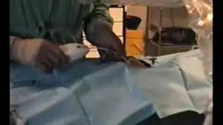 Epiduroscopy - Anaesthetic Techniques