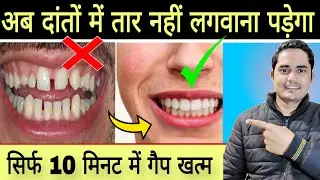  Danton Ka Gap Kaise Band Kare ? How to Close Gap Between Teeth Without Braces