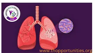 THO - TUBERCULOSIS- kifua kikuu