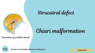 Chiari malformation: Causes and symptoms
