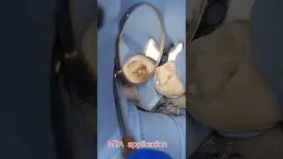 اصلاح انثقاب في قاع الحجزة اللبية perforation