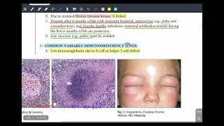 Primary Immunodeficiency| B-Cell, T-Cell & Combined Defects (USMLE / NRE-1)9