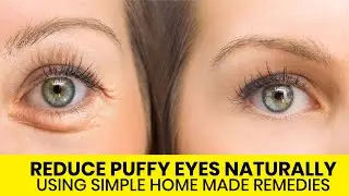 Home Remedies for Puffy Eyes I Treat puffy eyes naturally
