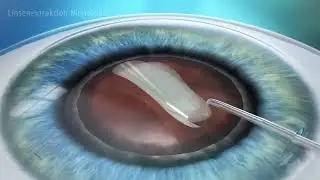 Linsenaustausch Monofokal CLE I Eyelaser Wien & Z&uuml;rich