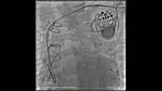 Abnormally Enlarged Singular Thebesian Vein in Right Atrium