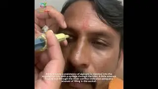 Artificial eye making| Prosthetic eye| Eye impression #prostheticeye #losteye #artificialeye
