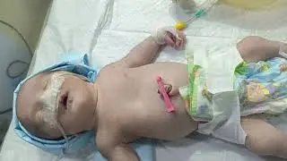 A severe distressed baby received with RDS and many more complications.