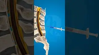 What is spinal anesthesia #hospital #doctor #newbornbaby #science #ultrasound #injection