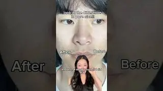 How I changed my bf&rsquo;s pore size! #skincare #poreminimization