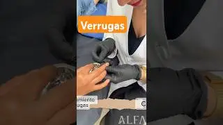 Eliminaci&oacute;n Verrugas con NITR&Oacute;GENO L&Iacute;QUIDO #verruga #dermatologo #cuenca