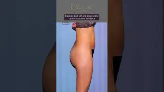 What is Buttock Lift? 🍑