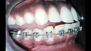 Completed Treatment for Scissors Bite| Collapsed Occlusion | Bad Overbite | Braces & Orthodontics 