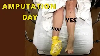AMPUTATION DAY Day 1 Of Being An Elective Amputee. My Husband's Reaction To My Amputated Foot