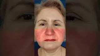 Before & After: Tratamentul rozaceei cu laser vascular