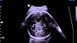 Septo-optic dysplasia, de Morsier syndrome