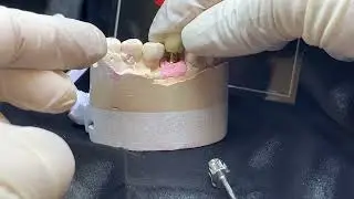 Single Implant Verification Jig