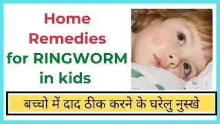 Home Remedies for Ringworm in Kids | Baccho me Daad ke liye gharelu nuskhe