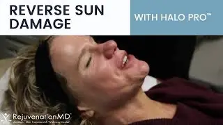 See Halo Pro&trade; Hybrid Fractional Laser In Action! Reverse Sun Damage