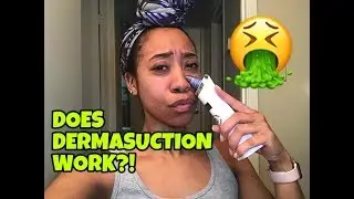 MUST SEE: Dermasuction Review 🤢