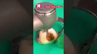 Dental Cavity Drilling #shorts