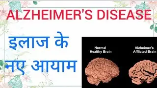 ALZHEIMER'S DISEASE:NEW DEVELOPMENT IN DIAGNOSIS AND TREATMENT: HEALTH TIPS IN HINDI