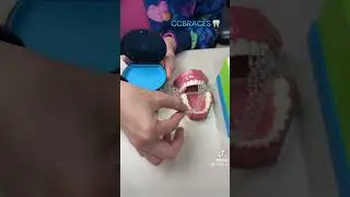 CC Braces Information for New Aligner Patients (please review before your Invisalign appointment.