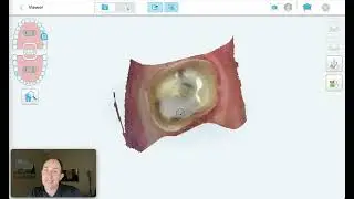 iTero Scan/Case Review - Crowns 13,14,29 (biocopy, copy restorative site anatomy)