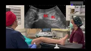 (English Narration Version) BIFES block: a novel RA technique for the posterolateral knee 