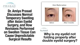 Why Double Eyelid Surgery Swelling can Take Months to Resolve, & Patience before Any Revision