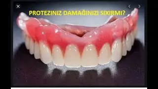 AĞIZDA OLAN PROTEZLƏR DAMAĞINIZI ƏZİRSƏ - BƏYAZDENT