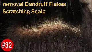 BIG FLAKES | Huge Flakes | removal Dandruff Flakes Scratching Scalp #32