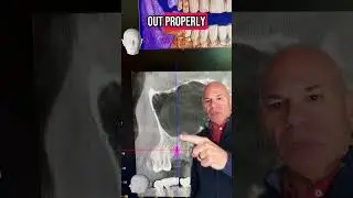Dental implant planning with a lateral sinus lift.