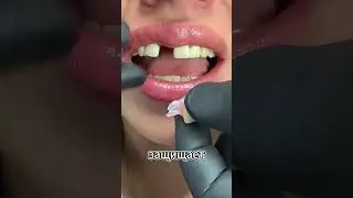 Протез бабочка как временное решение