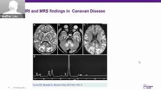 Diagnosis and Clinical Management of Canavan Disease