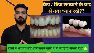 दांतो मे कैप या ब्रिज लगवाने के बाद यें बाते ध्यान रखे!